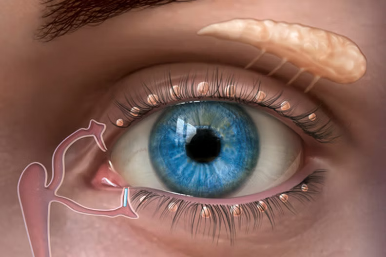 What Is Dry Eye?