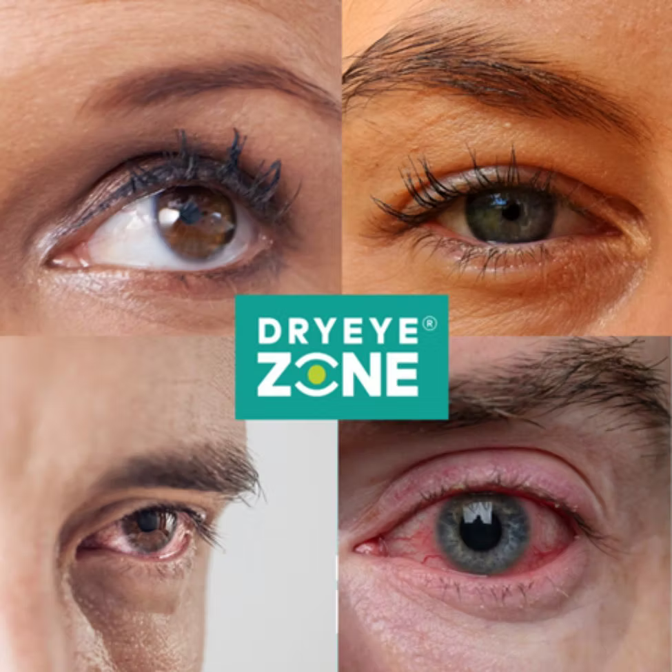 The Are 4 Stages of Dry Eye Disease - Where Are You?