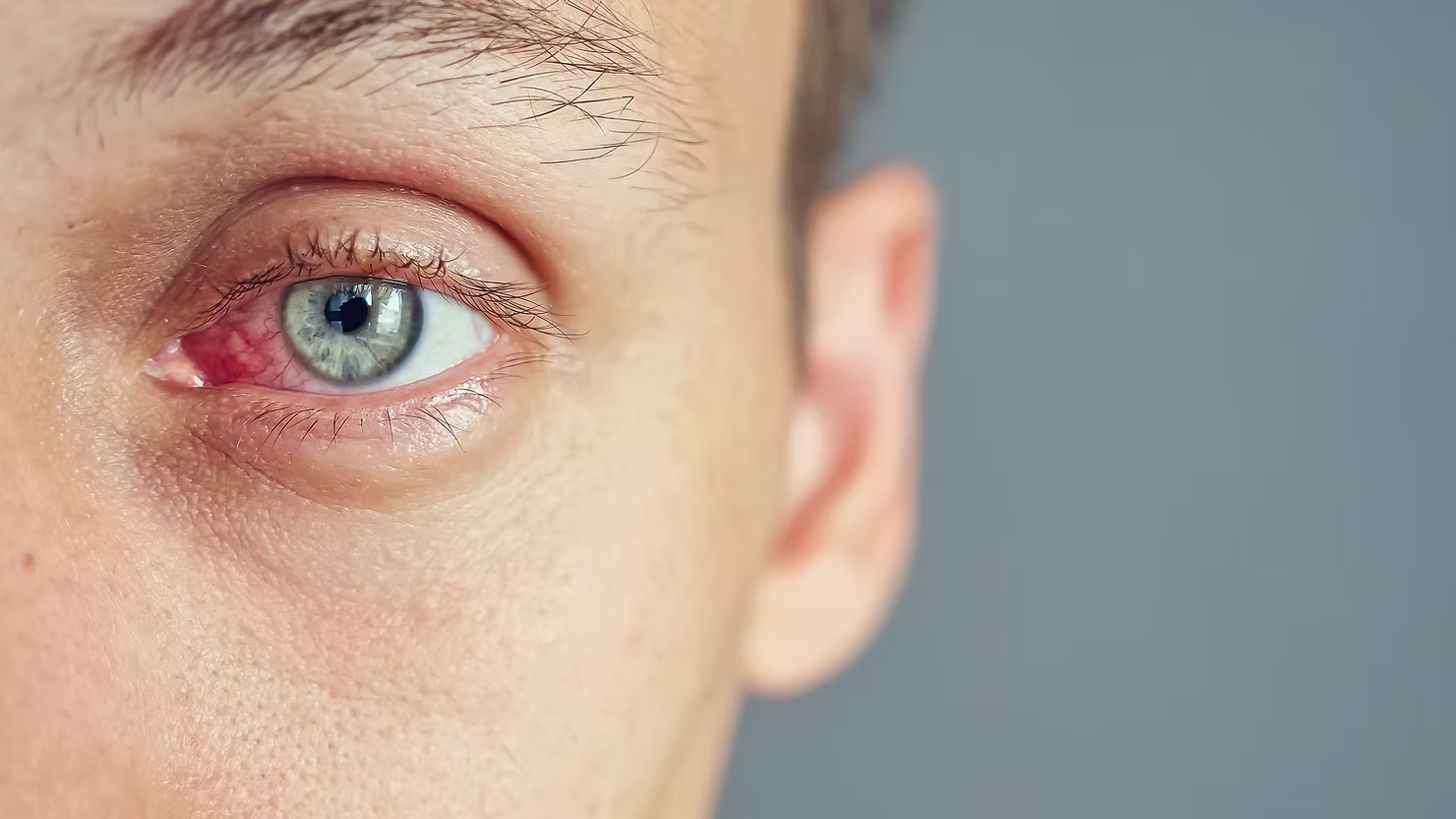 What Is Blepharitis?