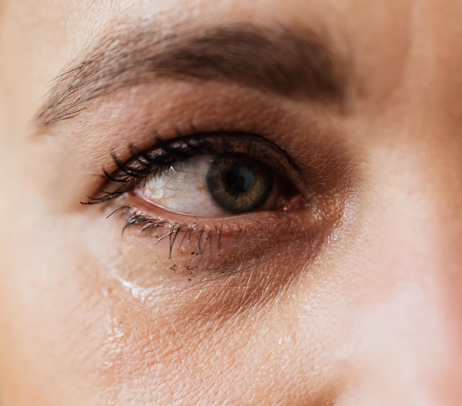 Dry Eye Is An Inflammatory Condition