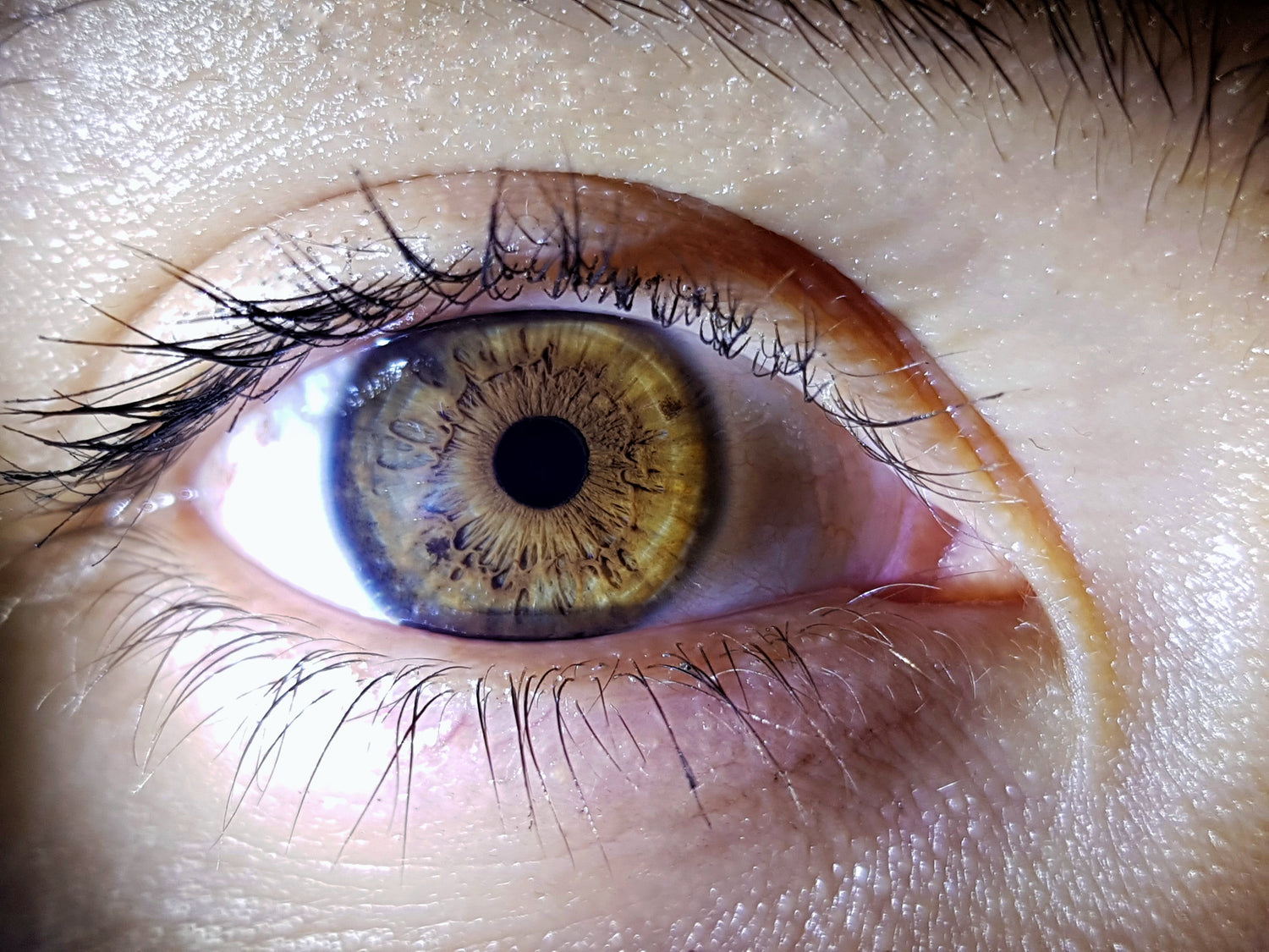 Can My Dry Eye Be Cured?